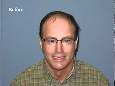 dr larry shapiro hair transplant review