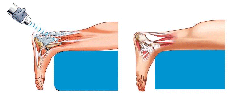 shock wave therapy for heel pain reviews