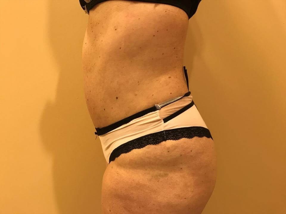 tummy tuck reviews before after