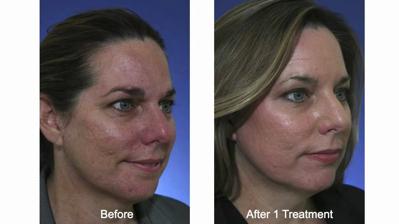 co2 laser for acne scars reviews